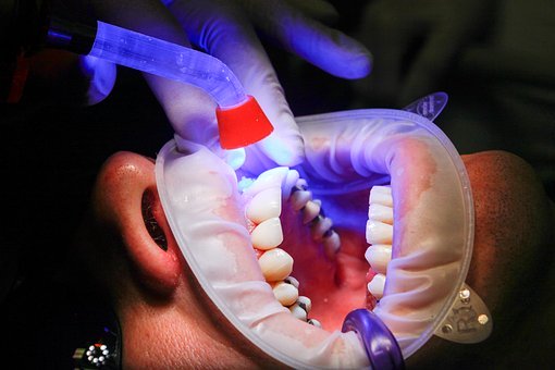 laserowe wybielanie zębów szczecin